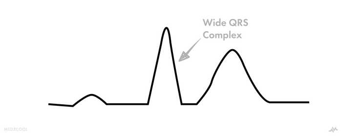 ECG findings in hyperkalemia >7.0 mEq/L