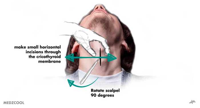 Cricothyroidotomy procedure