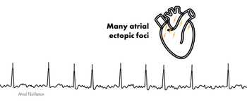 atrial flutter causes during pregnancy atrial flutter causes during pregnancy