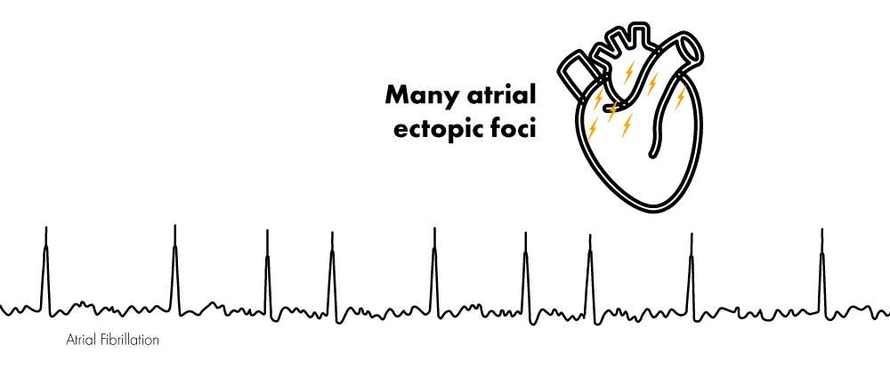 Atrial Fibrillation Vs Atrial Flutter Nucleotype