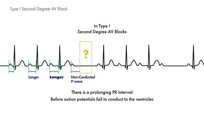 Mobitz Type I Second Degree AV Block