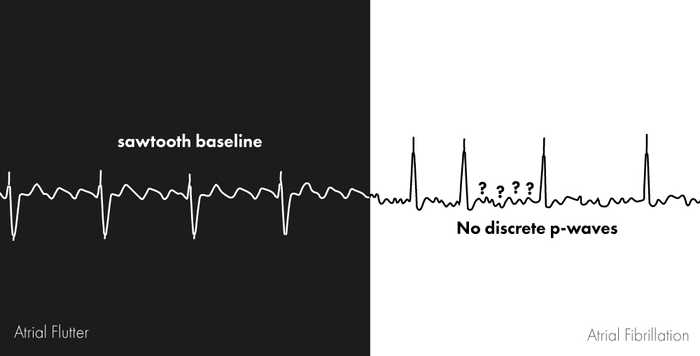 Atrial fibrillation vs flutter p-waves