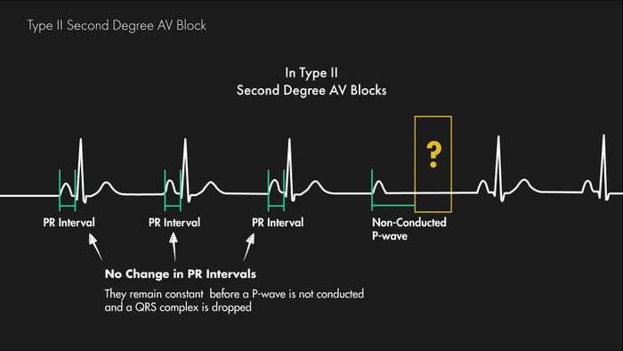 Mobitz Type II Second Degree AV Block