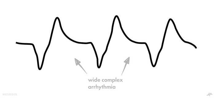 Wide complex electrocardiogram in hyperkalemia