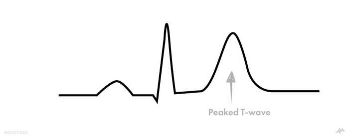 ECG findings in hyperkalemia >5.5 mEq/L