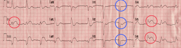 Sgarbossa Example