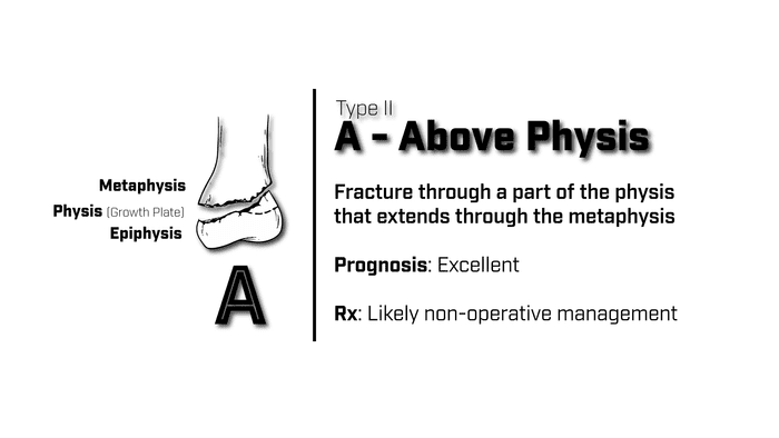 Type 2 Salter Harris Fracture