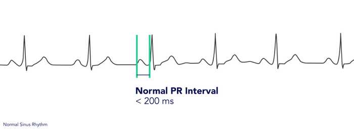 Normal PR Interval