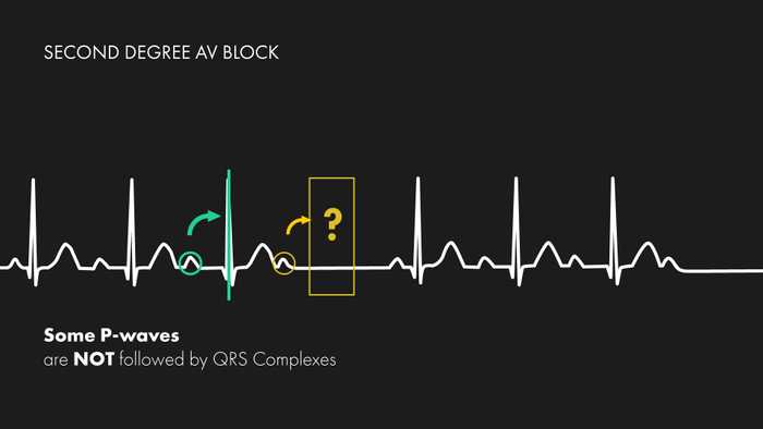 Second Degree Heart Block - Example of a Mobitz type I