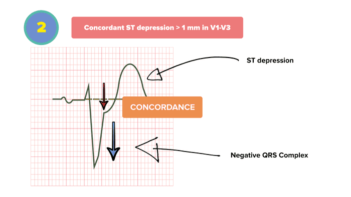 Sgarbossa Criteria 2 - CONCORDANT ST DEPRESSION