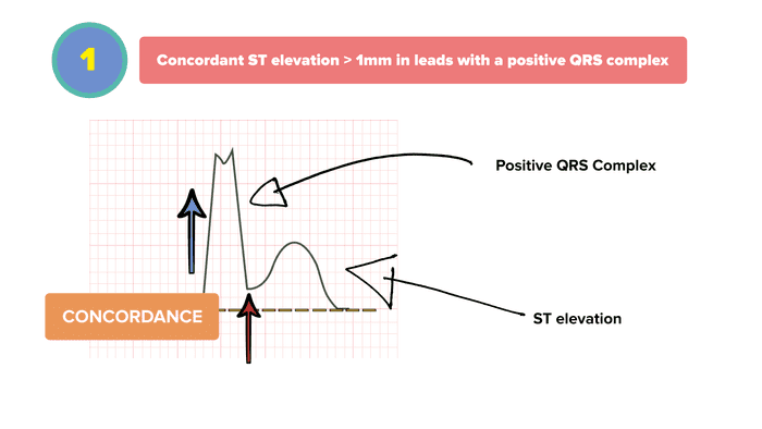 Sgarbossa Criteria 1 - CONCORDANT ST ELEVATION