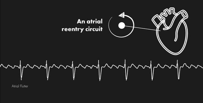 Atrial Flutter