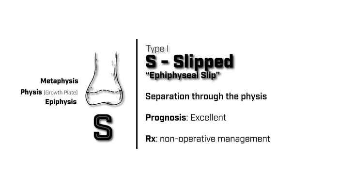 Type 1 Salter Harris Fracture