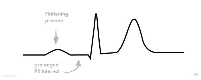 ECG findings in hyperkalemia >6.5 mEq/L