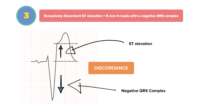 Sgarbossa Criteria 3 - EXCESSIVELY DISCORDANT ST ELEVATION