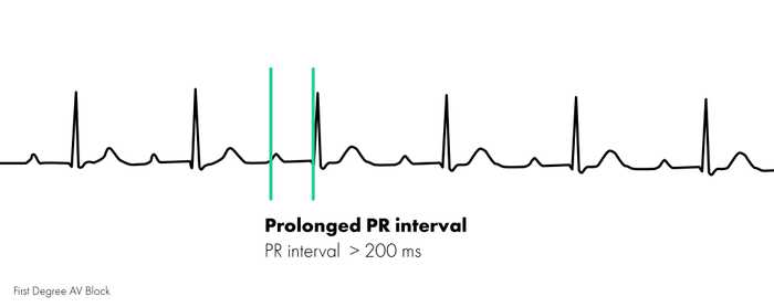 First Degree Heart Block - Prolonged PR Interval