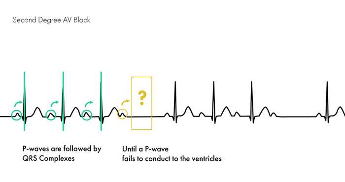 Example of a Second Degree AV Block