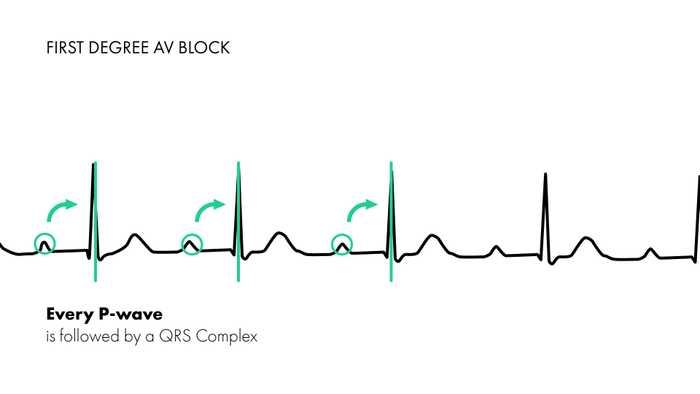 First Degree Heart Block - P-waves followed by QRS complexes