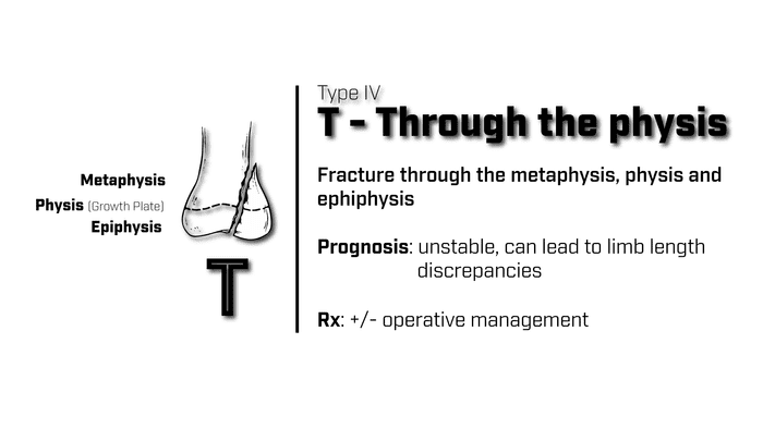 Type 4 Salter Harris Fracture